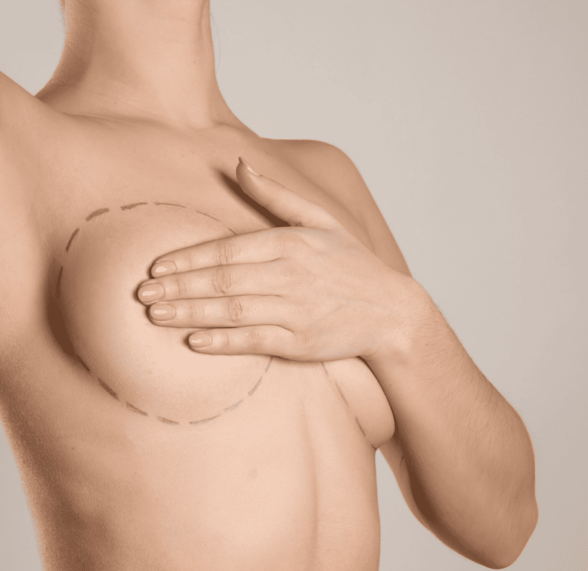Breast Implant Illness is a term that has emerged from the collective experiences of women who report a range of symptoms after undergoing breast augmentation.